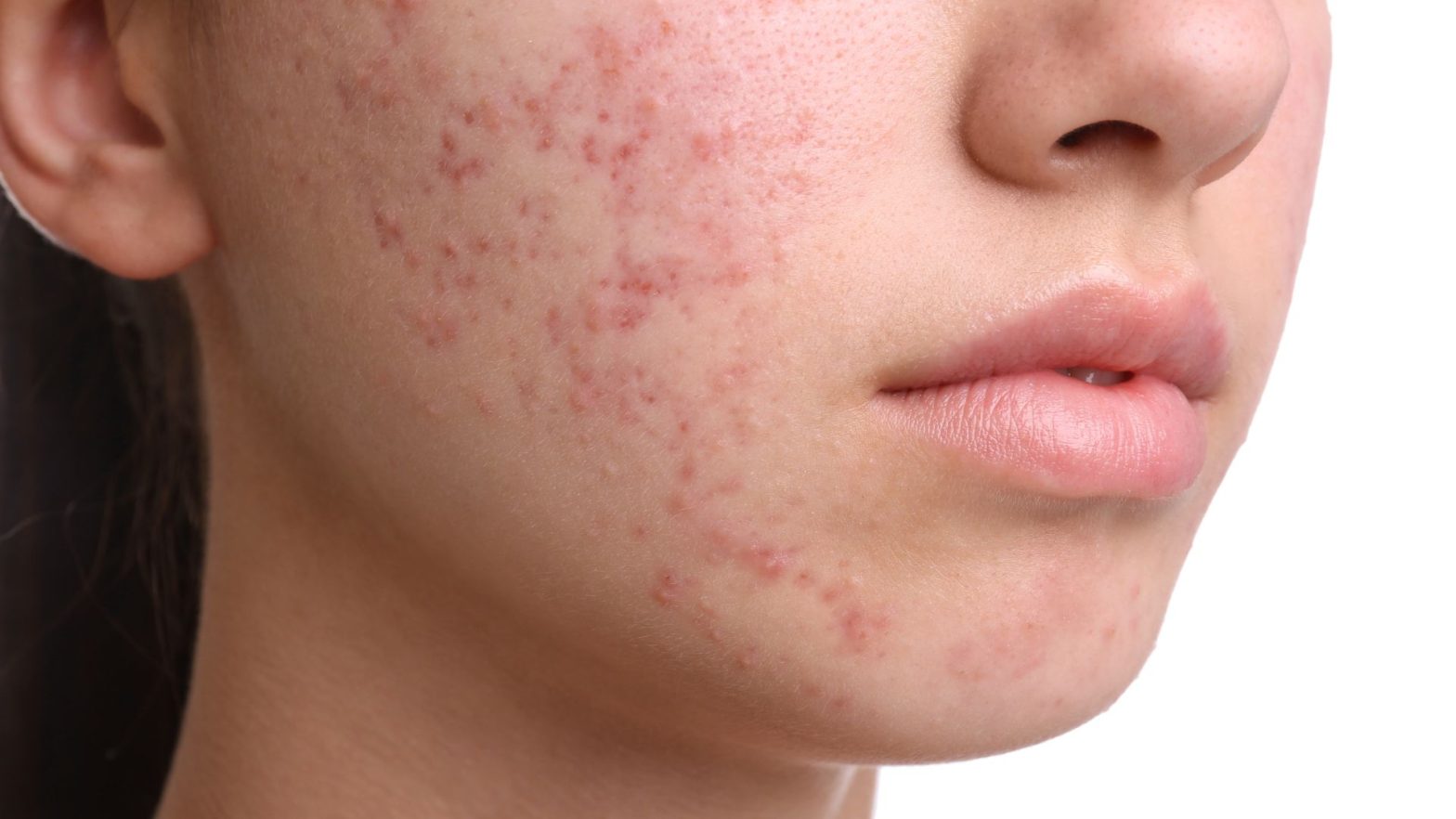 Hormonal Acne