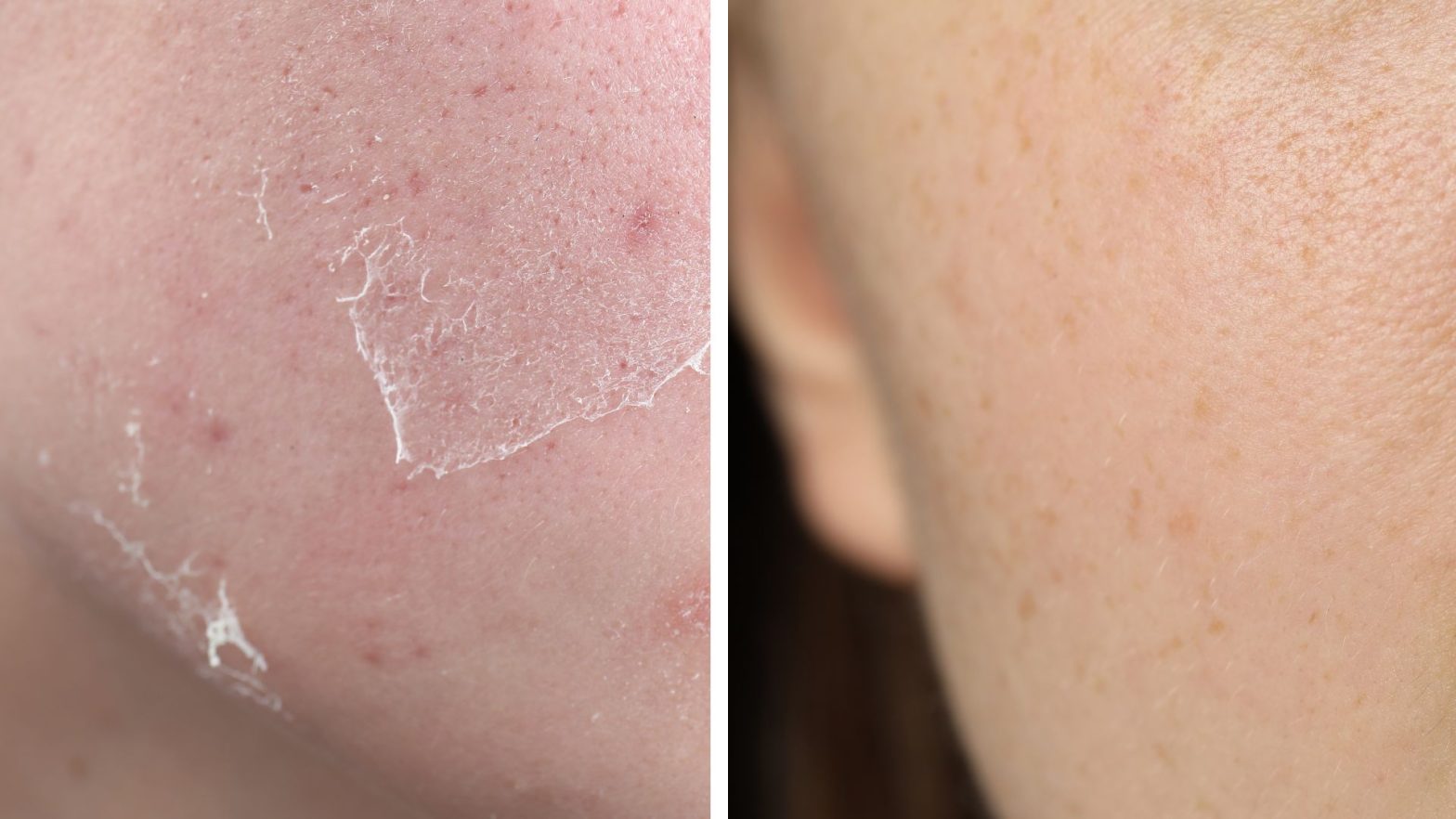 Dry skin vs dehydrated skin