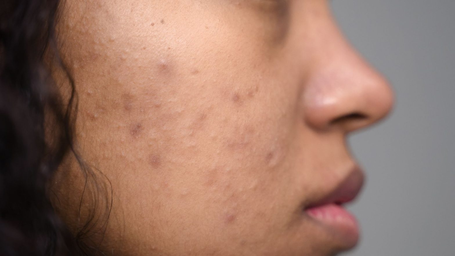 how to fade acne scars