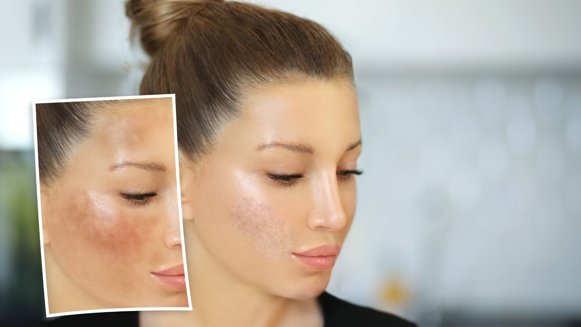 melasma vs dark spots